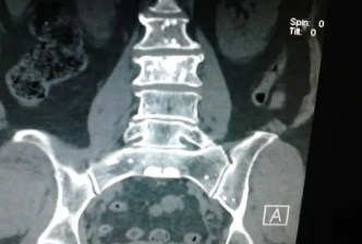 肺癌骨转移的治疗目的是减轻骨痛提高生存质量和延长生存期