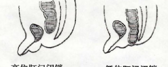 肛门闭锁后遗症并发症