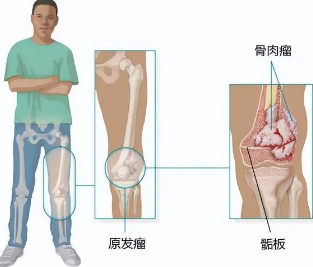 为什么会得骨癌