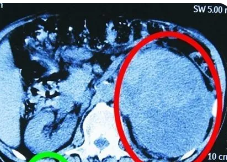 左肾肿瘤10厘米严重吗