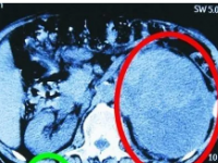 左肾肿瘤10厘米严重吗