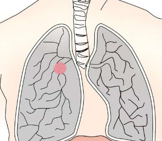 预测未来十年内人们患肺癌风险的新工具