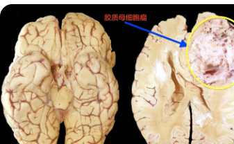 利用细胞自我毁灭治疗胶质母细胞瘤