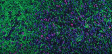反义寡核苷酸有助于治疗小鼠致命的脑癌