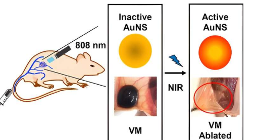 金纳米粒子和光可以融化静脉畸形
