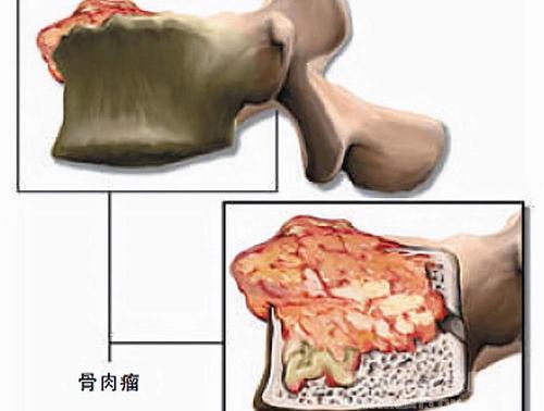 骨肉瘤的症状有哪些？孩子患骨肉瘤可以治好吗？ 骨肉瘤的早期症状