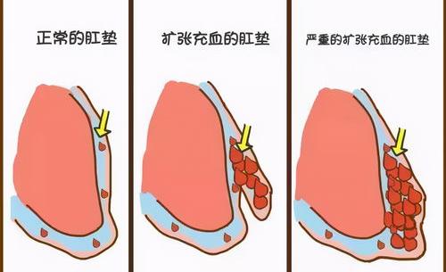 治疗痔疮最有效的偏方 痔疮怎么治疗最好偏方大全