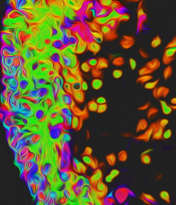 分子途径有助于确定年龄相关性黄斑变性类型