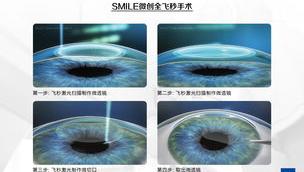 常见4种矫正近视的手术方式 全飞秒